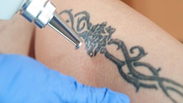 Conoc las tcnicas y tratamientos para la eliminacin de tatuajes
