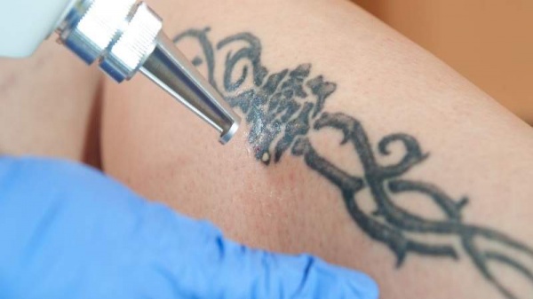 Ampliar Conocé las técnicas y tratamientos para la eliminación de tatuajes