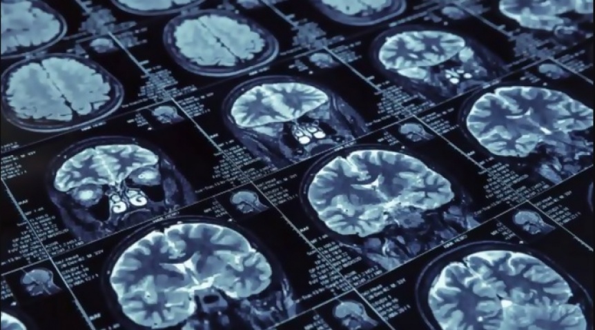 Ampliar Confirman la eficacia del primer medicamento contra el Alzheimer